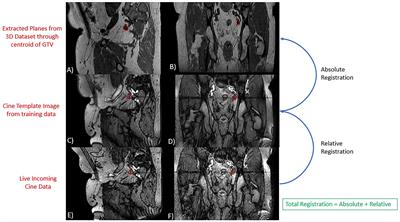 Intra-fraction motion of pelvic oligometastases and feasibility of PTV margin reduction using MRI guided adaptive radiotherapy